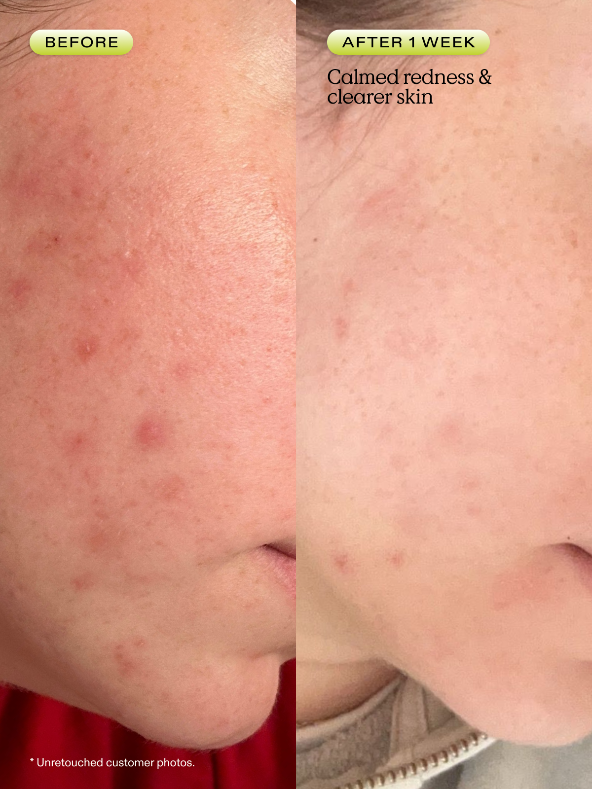 Before and after one week of using Matcha Hemp Hydrating Cleanser with calmed redness and clearer skin