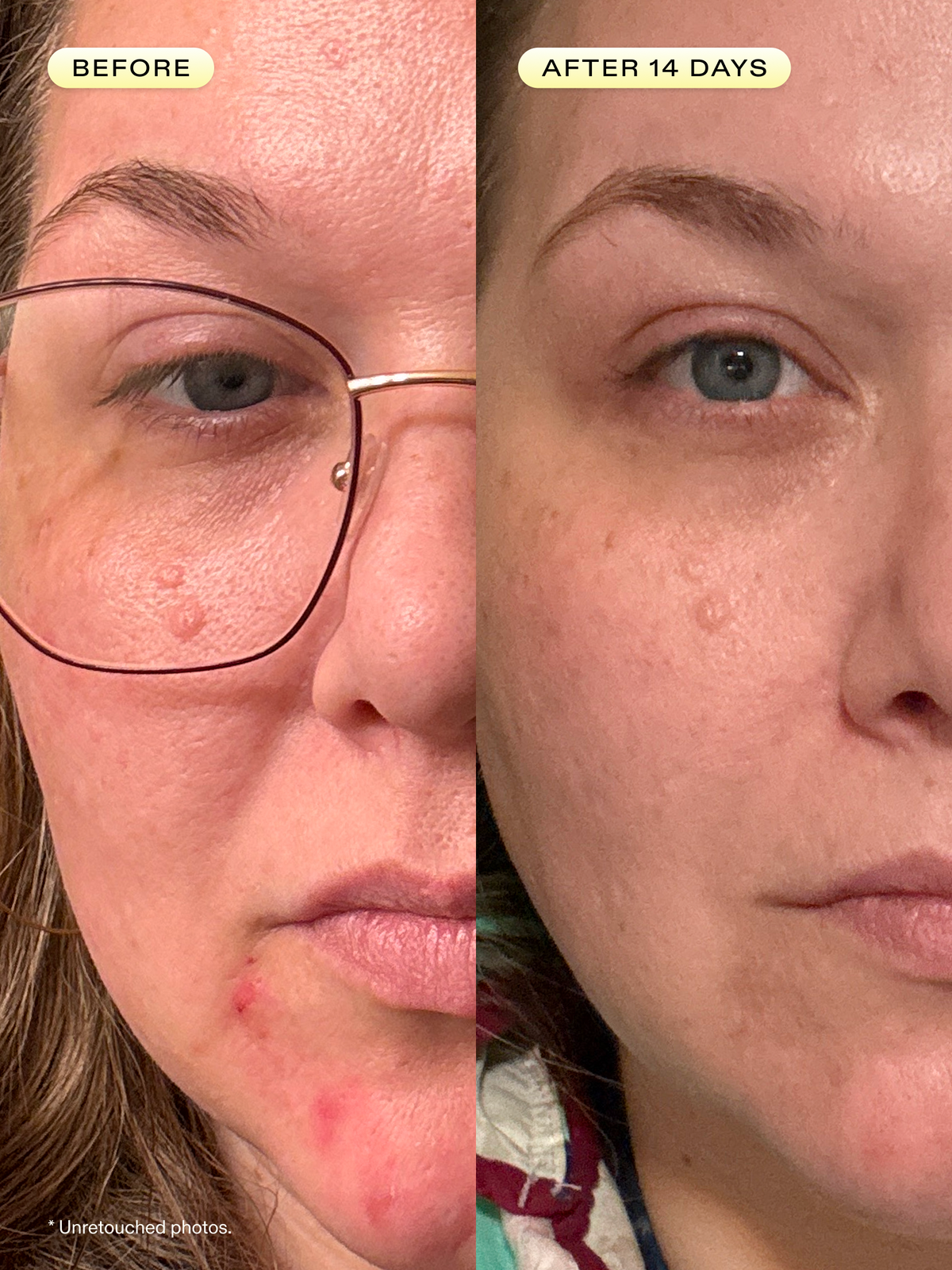 Before and after 14 days of using Oil La La